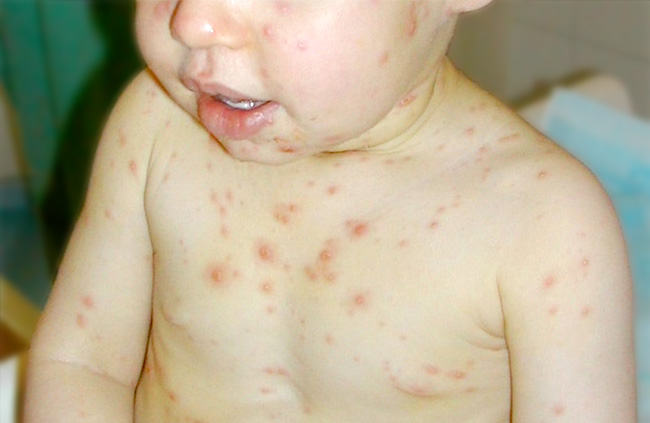 Casos de varicela preocupan a la comunidad caleña
