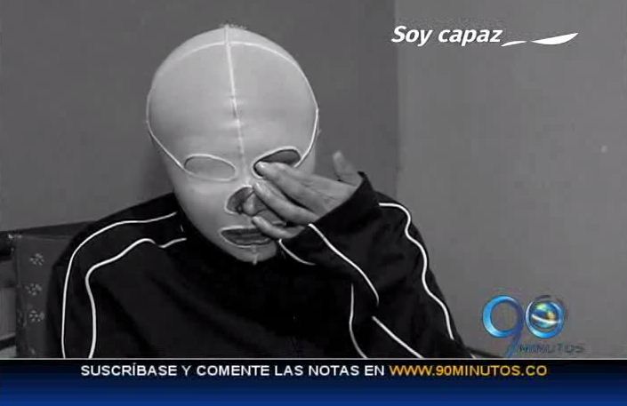 Mujer que fue atacada con ácido dijo que perdona a su agresor