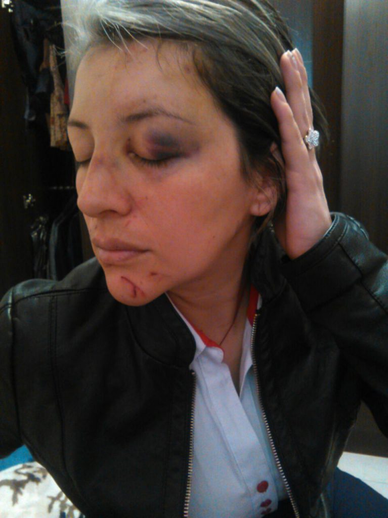 Mujer brutalmente agredida por desconocido en Pasto, denunció su caso