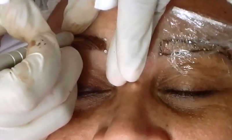 Mujer perdió la visión en uno de sus ojos luego de procedimiento estético en Cali