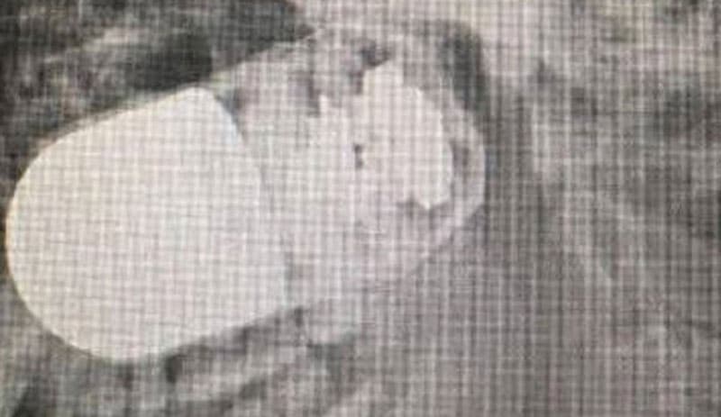 Extraen artefacto explosivo de la cabeza de un joven indígena en Cali