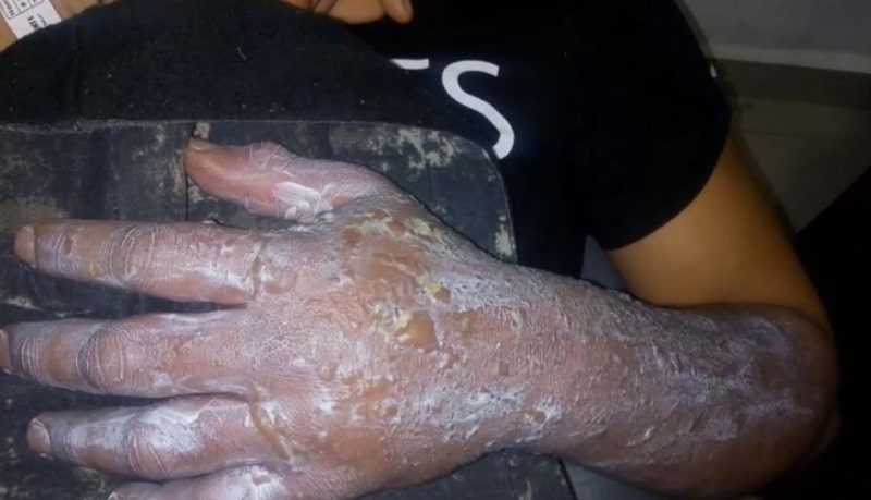 Por apuesta de un millón de pesos, joven caleño estaría a punto de perder su brazo