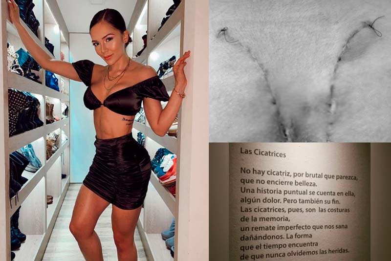 Lina Tejeiro mostró las cicatrices en sus glúteos tras ser operada por biopolímeros