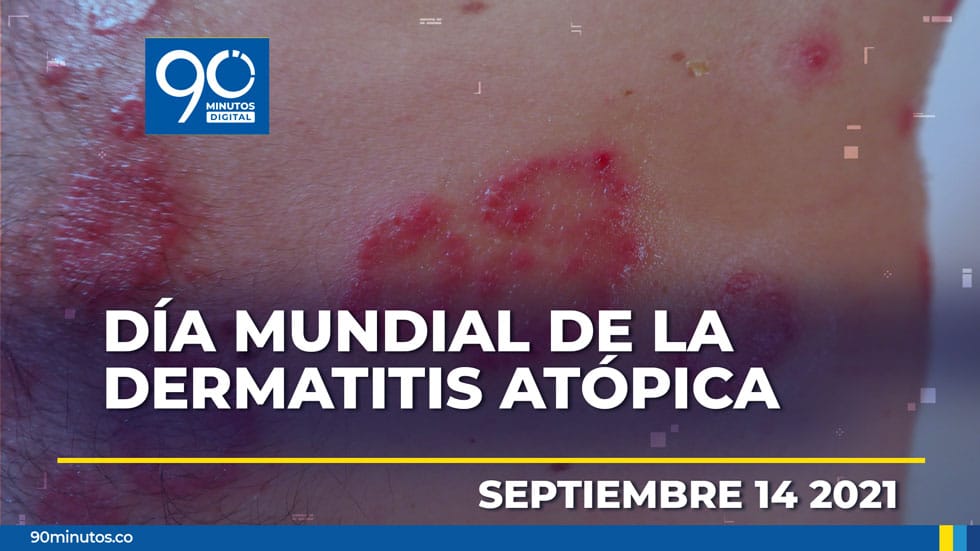 Rastros de la Dermatitis Atópica: más allá de la piel
