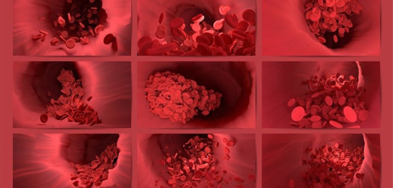 Trombosis: 1 de cada 4 personas en el  mundo muere por enfermedades asociadas