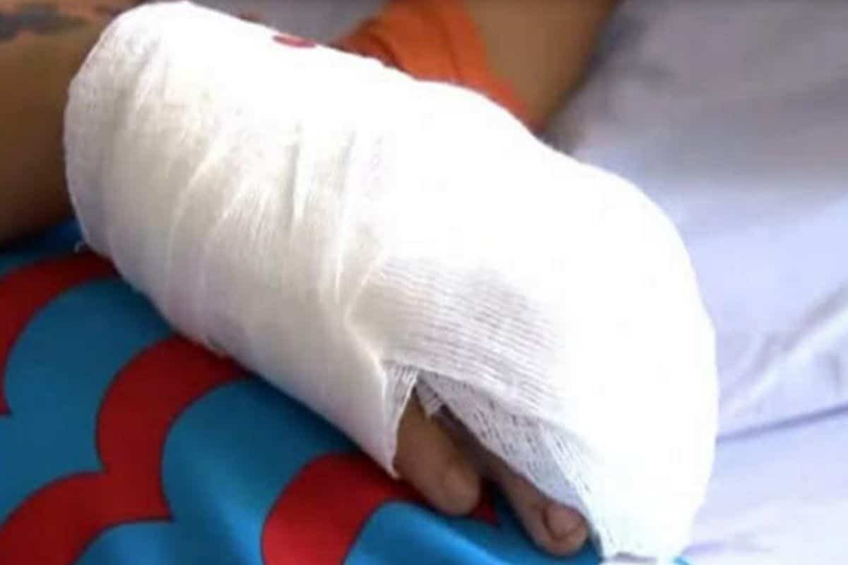 Menor de 10 años perdió dos dedos por tocar un ‘tumbarrancho’