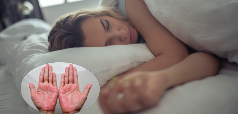 Día mundial del sueño: Conozca la relación entre dormir y la Dermatitis