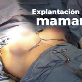 Explantación mamaria, una tendencia que aumenta por razones de salud