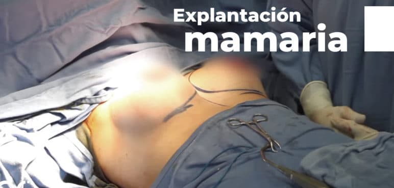 Explantación mamaria, una tendencia que aumenta por razones de salud