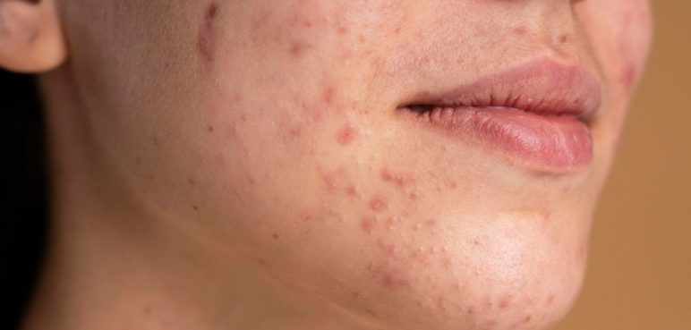 ¿Tiene acné? Estas son las recomendaciones para cuidar la piel