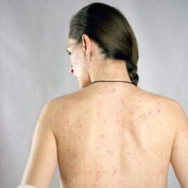 La viruela del mono tiene nueva variante: Hay alerta por emergencia sanitaria