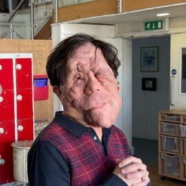 ¿Qué enfermedad padece Adam Pearson? El actor que rompe estándares en Hollywood