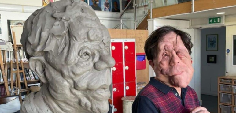 ¿Qué enfermedad padece Adam Pearson? El actor que rompe estándares en Hollywood