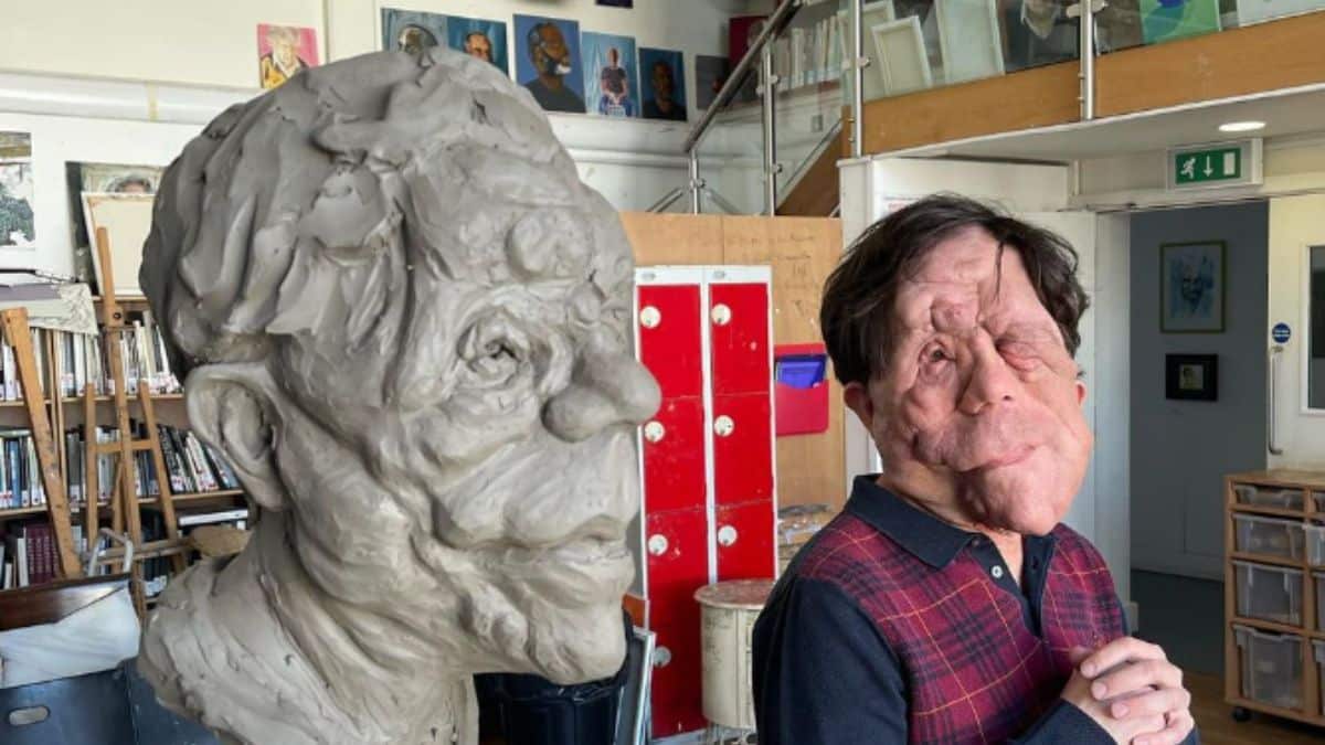 ¿Qué enfermedad padece Adam Pearson? El actor que rompe estándares en Hollywood