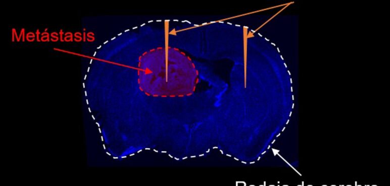 Avance científico permite detectar metástasis y lesiones en el cerebro, ¿de qué se trata?