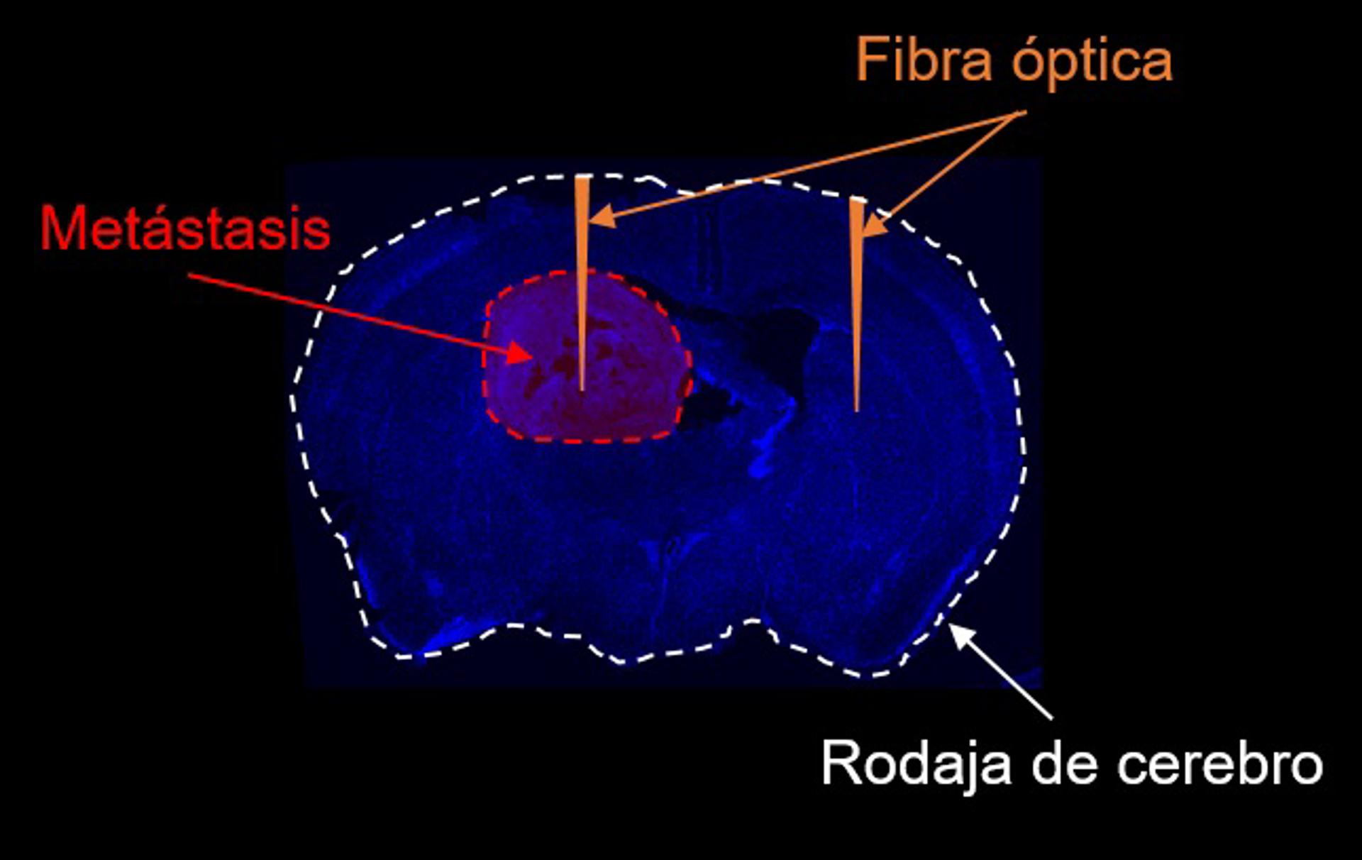 Avance científico permite detectar metástasis y lesiones en el cerebro, ¿de qué se trata?