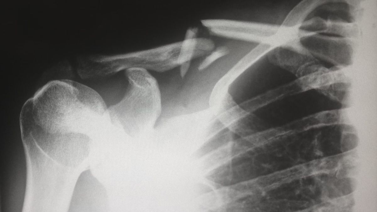 hueso-radiografia