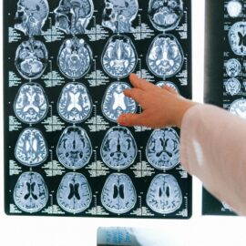 ¿Qué es un TAC cerebral y qué precauciones se deberían tener? 