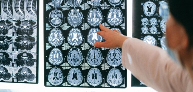 ¿Qué es un TAC cerebral y qué precauciones se deberían tener? 
