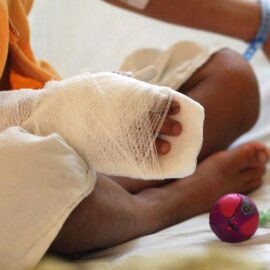 Aumentan los quemados con pólvora en el Valle del Cauca: autoridades en alerta