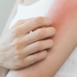 Conozca las causas y tipos de dermatitis; una enfermedad más común de los que se cree