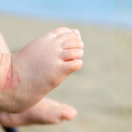 Ojo: Este es el mejor tratamiento para manejar la dermatitis en niños y adultos