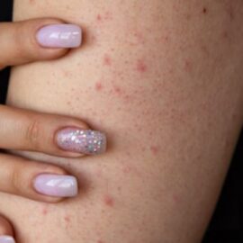 Todo sobre la queratosis y su impacto negativo en la piel: dermatólogo explica síntomas