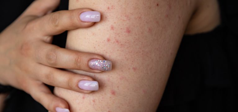 Todo sobre la queratosis y su impacto negativo en la piel: dermatólogo explica síntomas