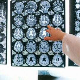 Un ataque cerebrovascular puede ser mortal: Así puede identificarlo y actuar a tiempo