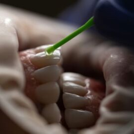 ¿Las carillas son buenas para los dientes o les hacen daño? Experta aclara duda
