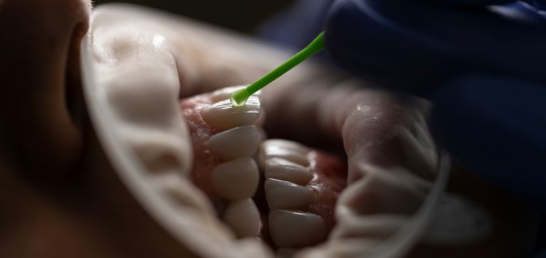 ¿Las carillas son buenas para los dientes o les hacen daño? Experta aclara duda