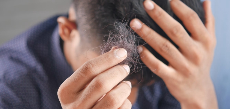 Mitos sobre la alopecia: experta brinda recomendaciones y despeja dudas