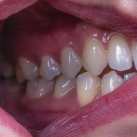 ¿Qué es el bruxismo? Síntomas y cómo puede afectar la salud de los dientes