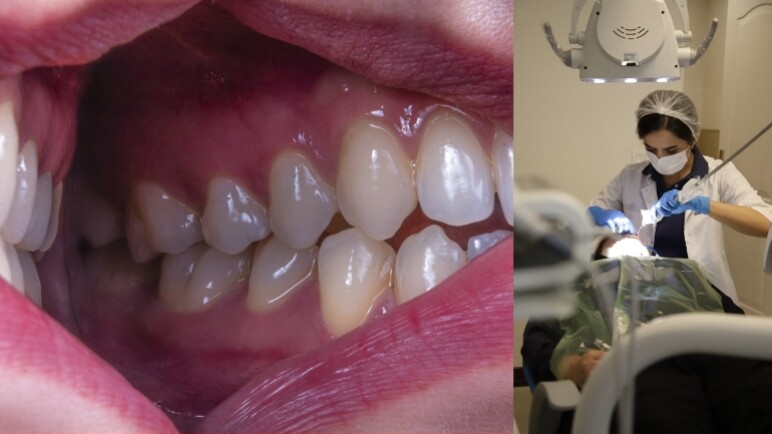¿Qué es el bruxismo? Síntomas y cómo puede afectar la salud de los dientes